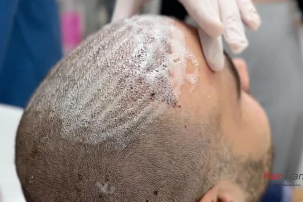 3.000 Greft Saç Ekimi