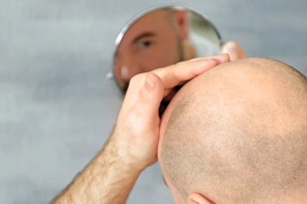 متى يبدأ الشعر المزروع بالنمو بعد العملية؟