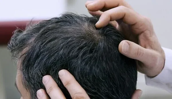 Welche Faktoren beeinflussen den Erfolg einer Haartransplantation?