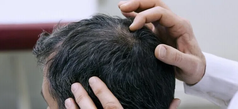 Welche Faktoren beeinflussen den Erfolg einer Haartransplantation?