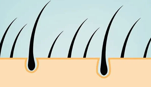 Vor- und Nachteile der FUE Haartransplantations-Methode