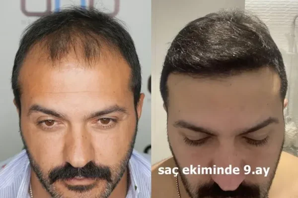 Az Dökülmüş Saça Saç Ekimi