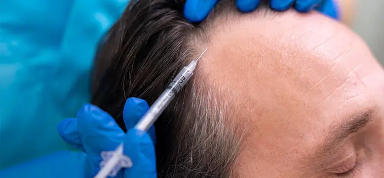 Stem Cell Hair Treatment: A Natural Solution for Hair Loss