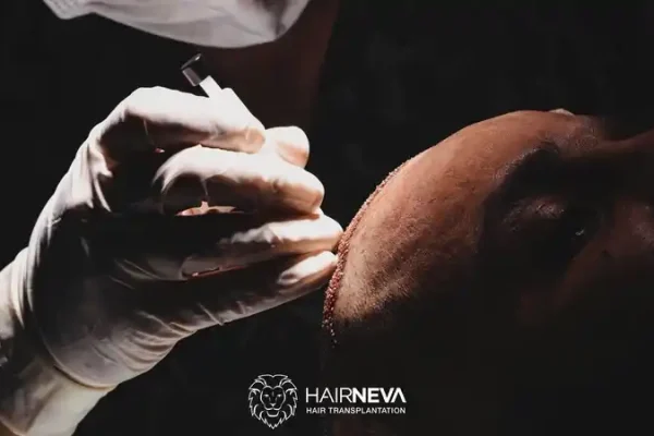 Expertenklinik für natürliche Ergebnisse bei Haartransplantationen