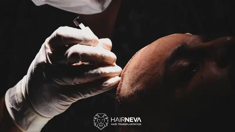 Best Hair Transplant Clinic in Turkey 2 Best Hair Transplant Clinic in Turkey