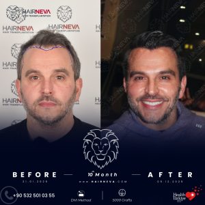 Natural Widow’s Peak Hairline Restoration Design 2 Natural Widow’s Peak Hairline Restoration Design