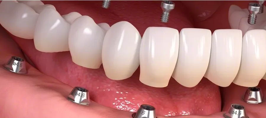 Implant Supported Prosthesis