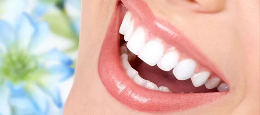 Porcelain Laminate Veneers