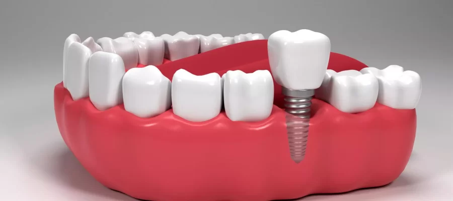 dental-implants-turkeyy
