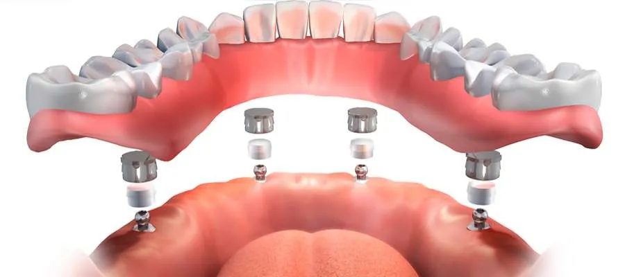 full-teeth-implants-in-turkey