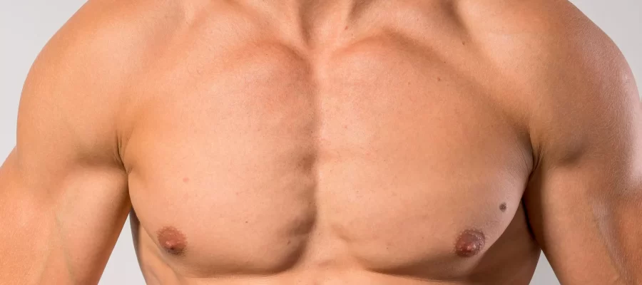 gynecomastia