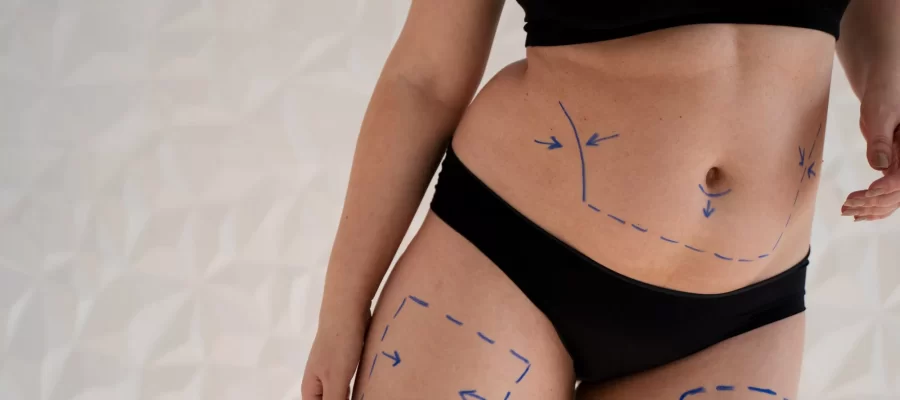 liposuction