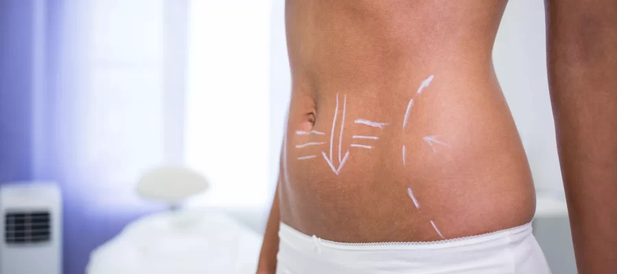 tummy-tuck
