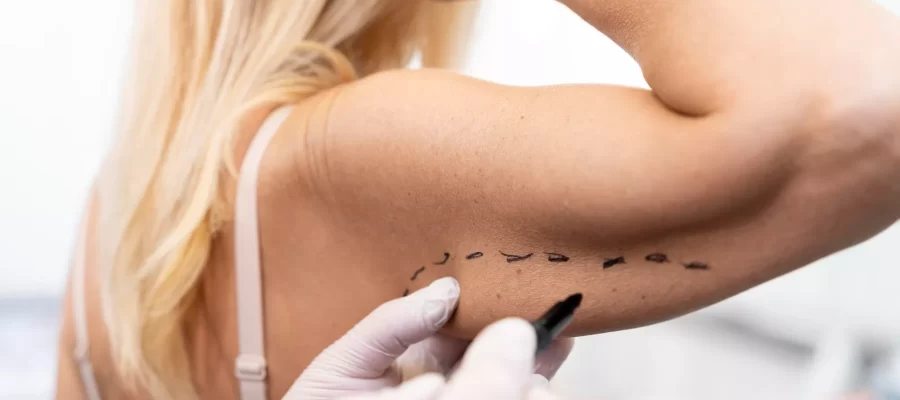 upper-arm-aesthetics
